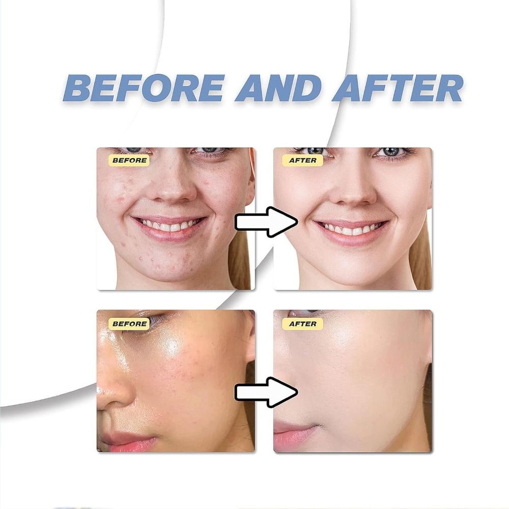 Azelaïnezuur 12% 20% Serum Aze - Azelaic Acid Serum recensie en prijs