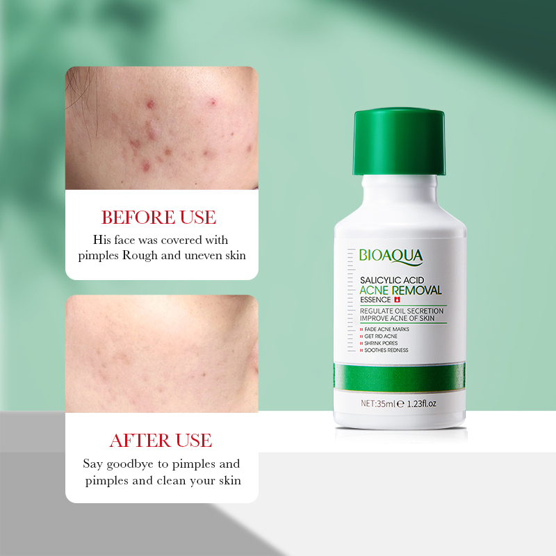 35ml BIOAOUA Salicylzuur Anti- - Azelaic Acid Serum recensie en prijs