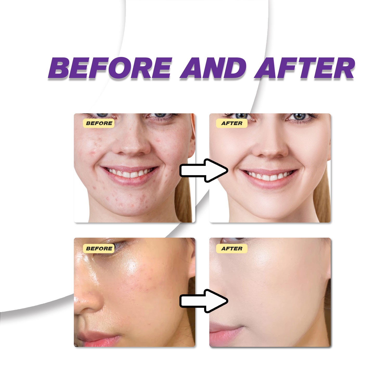 Milde Azelaïnezuurcrème verbet - Azelaic Acid Serum recensie en prijs